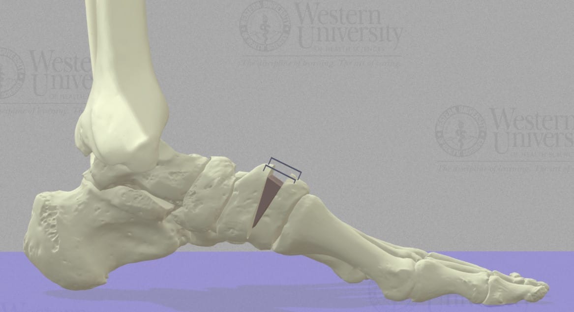 Illustration of a human foot skeleton side view, showing a metal implant on the heel bone.