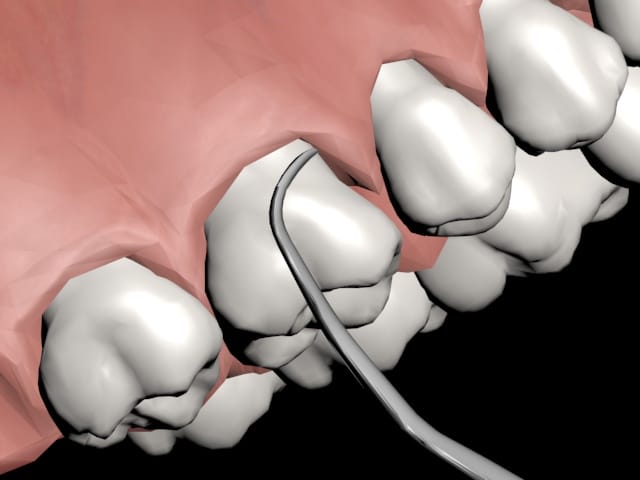 Digital rendering of teeth and gums with a dental instrument touching the gum line, demonstrating a dental examination or procedure.