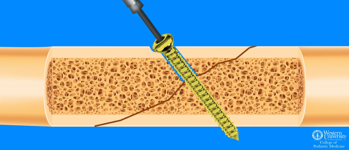 Image of a slide explaining the surgical instruction on the screw insertion technique from College of Podiatry